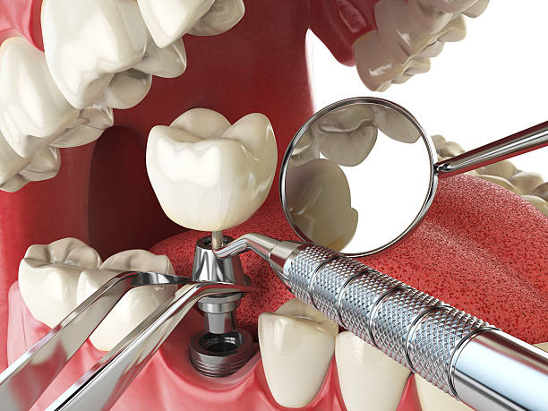Best Urgent Care for Lost Fillings or Crowns in Towaco, NJ